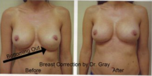 Type II Deformity on the left.